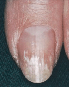 Onychomycose granulation de kératine